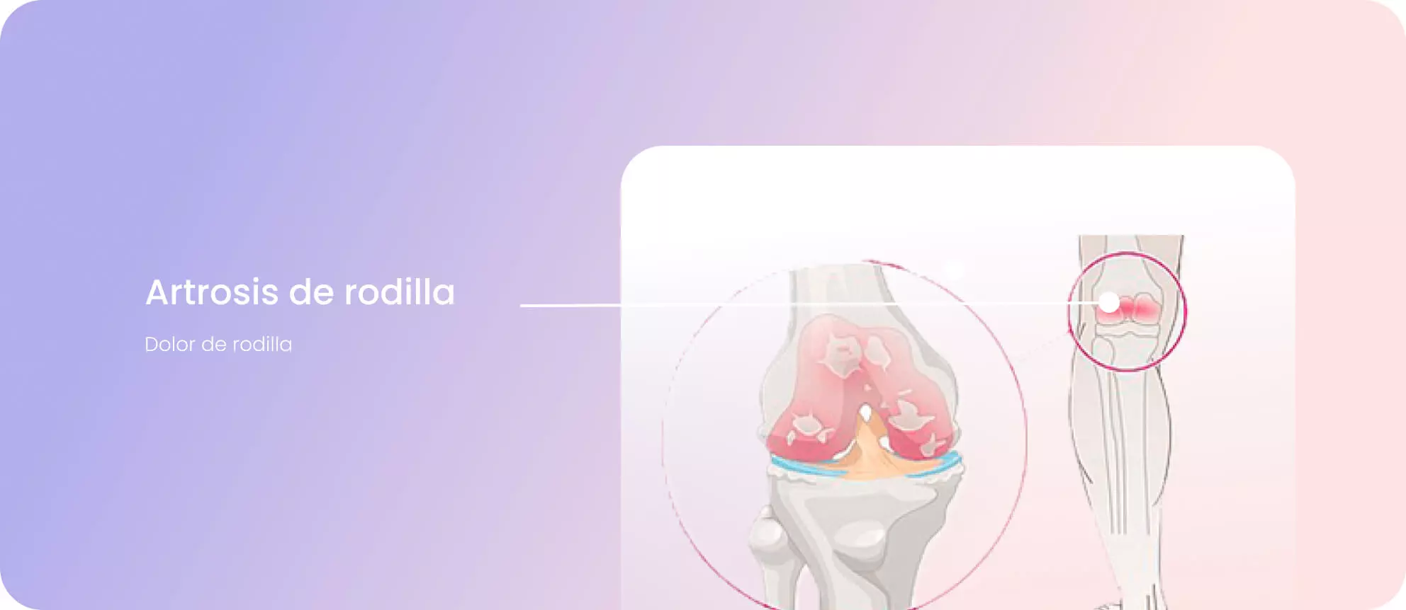 Artrosis de rodilla